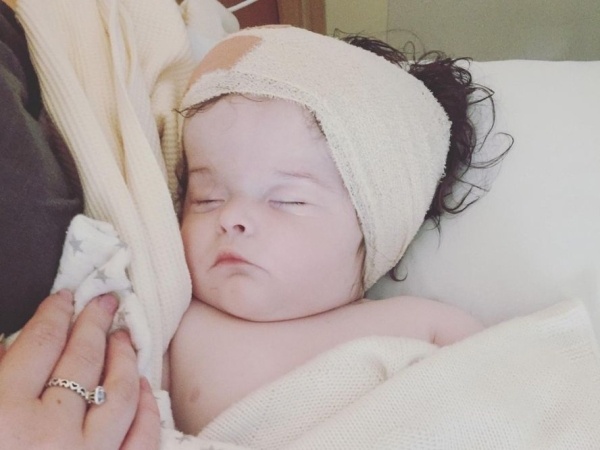 Baby girl recovering from brain surgery